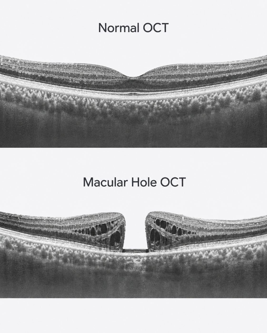 Normal OCT compared with macular hole OCT