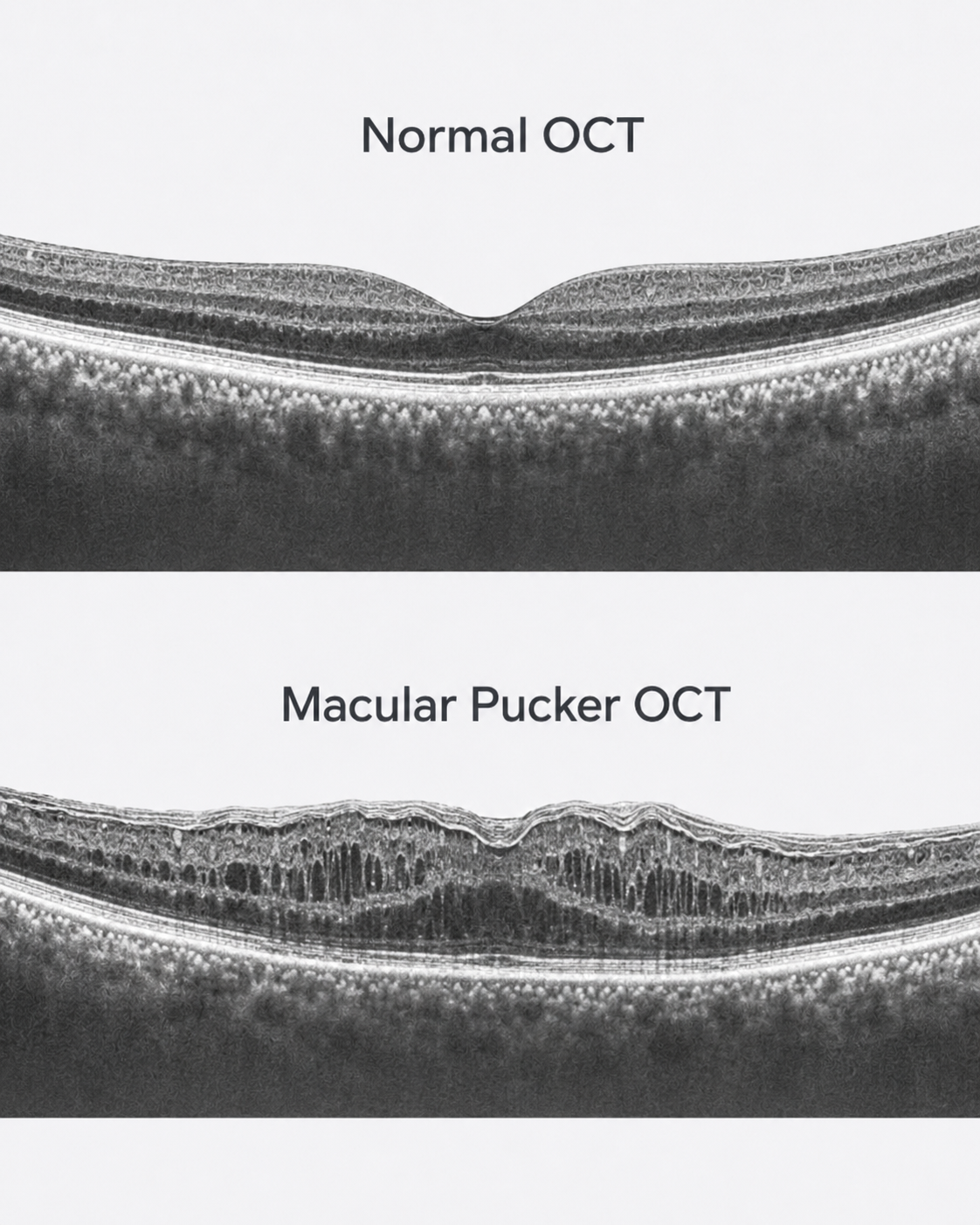 Normal OCT compared with macular pucker OCT